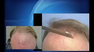 2500 grafts, finer hair, 9 months, mid-50's male frontal hair transplant by Dr. Lindsey in McLean VA