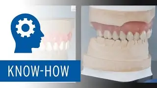 Ceramill FDS &ndash; Digitales Design von Einzelkiefer-Prothesen