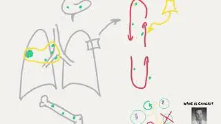 Doctor Explains How Cancer Starts, Spreads and How Cancer is Treated