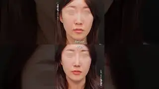 Menemukan Diri Baru: Hari ke-7 Setelah Operasi Hidung!