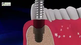 Dental Implant Removal