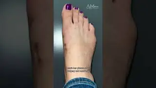 You Won't Believe How This Bunion and Bunionette Are Transformed After AMI&reg; Treatment!