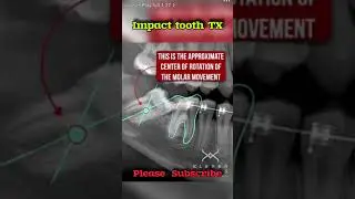 Can Braces Fix an Impacted Tooth? Here's How
