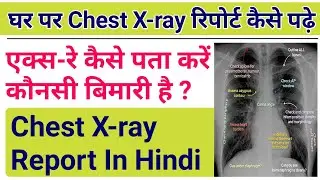 Chest X-ray रिपोर्ट पढ़ना सीखें Chest X ray Report कैसे Read करें || How to read chest X-ray report