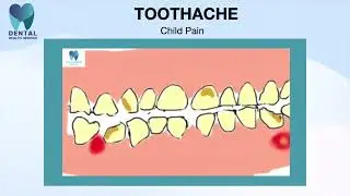 DP10 child dental pain, teeth eruption pattern, teething, abscess options, avoid General Anaesthetic