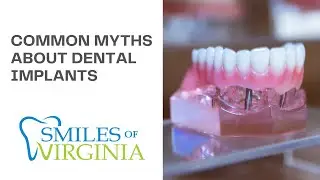 Common Myths About Dental Implants