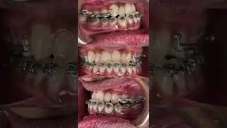 &ldquo;Transforming smiles with facemask therapy! 🦷✨ #thesmiledesigners #dentist #smiledesigning #shorts