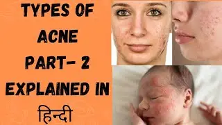 #part2 | TYPES OF ACNE | Explained In हिन्दी | आसान भाषा में | #study