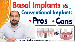 Advantages of Basal Implants Over Conventional Options || Dental Implants || Eledent Dental Hospital