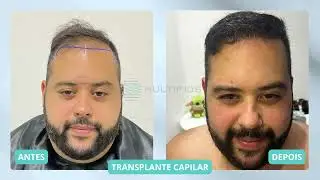 MULTIFIOS ANTES E DEPOIS