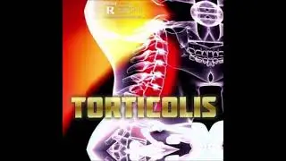 William Skuu - Torticolis