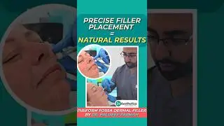 Piriform Fossa Dermal Filler  Safe Deep Injection Technique by Dr. Farmah