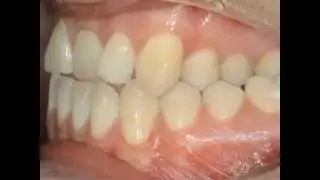 Braces Behind the Teeth in Seattle WA by Orthodontist Dr. Christopher Riolo