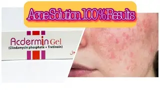 How To Remove Red Acne Scars From Face | Remove Pimples Marks | Acne Treatment |
