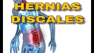 COMO MEJORAR SIN CIRUGIA - hernias discales sintomas recuperacion estiramientos hernia discal