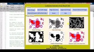 Matlab Code for Leukemia Detection from Blood Cells Full Source Code