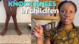у детей искривление коленных суставов