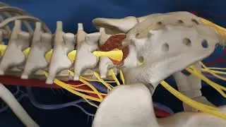 KEY HOLE SPINE SURGERY