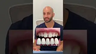 Fort Lauderdale Orthodontist/Invisalign Specialist does a case review with a 4-month progress (2024)