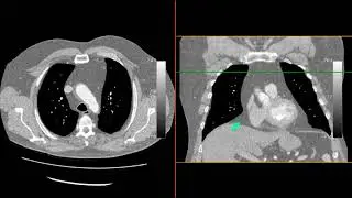 Pseudopleural plaque