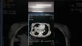 CT scan of chest  with contrast,, #ctscan #medicalimaging #anatomy #biology #chestscan