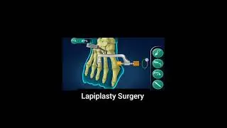 lapiplasty Surgery 3D animation surgery