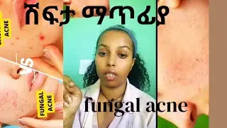 የፈንጋል አክኔ (Fungal Acne) ምንድን ነው? | ልዩነቱና የተፈጥሮ መፍትሄዎቹ በአማርኛ | Home Remedies