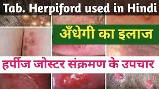 Herpiford 400 DT Uses in Hindi | हर्पीज जोस्टर संक्रमण के उपचार | Aciclovir 400 Uses in Hindi #real