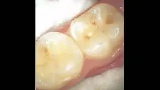 Vineland Dentist - Dr. David Brown Demonstrates the Diagnodent