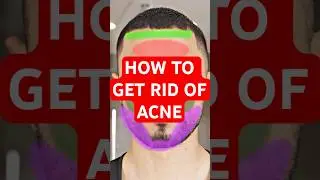 WANT TO KNOW HOW TO get rid of acne? #howto #tutorial #acne #diy