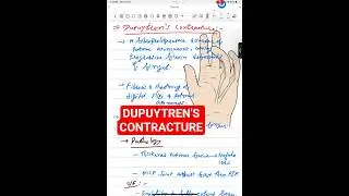 DUPUYTREN&rsquo;S CONTRACTURE #anatomy #biology #science