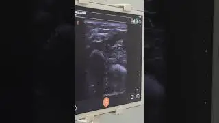 İnjection for Tremor via Bimodal Botox Technique (plexor pollicis longus muscle injection)