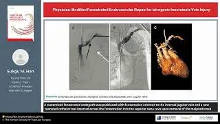 Physician-Modified Fenestrated Endovascular Repair for Iatrogenic Innominate Vein Injury