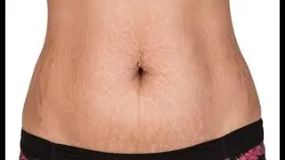 How To Get Rid Of Stretch Marks Fast - Stretch Marks Home Solution