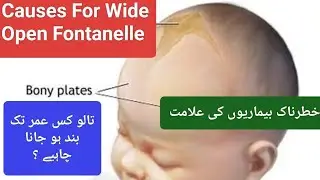 Causes For Wide Open Fontanelle | Why Soft Spot Is Open | Bulging Soft Spot in Babies