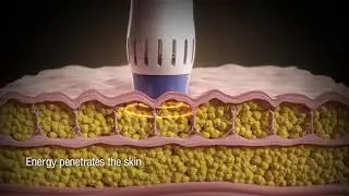 Zimmer ZWavePro en Cl&iacute;nica Dermik