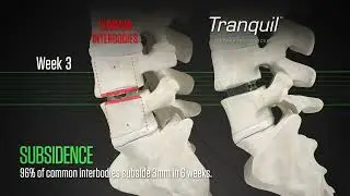 Nexus Spine Tranquil&trade;
