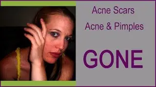 How To Get Rid Of Pimples and Prevent Acne, DIY Home Treatment With Baiden Mitten (true story)