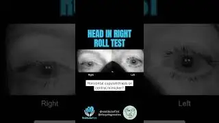 Apogeotropic horizontal nystagmus &ndash; Is it horizontal cupulolithiasis BPPV or vestibular migraine?