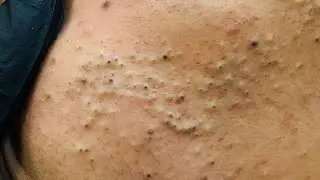 facial care routine | Natural Remedies for Acne and Blackheads