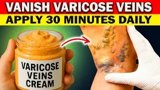 This Natural Mixture Is Trending to Help VANISH Varicose Veins
