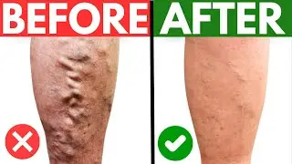 Signs of POOR CIRCULATION and the BEST TEA to REDUCE VARICOSE VEINS