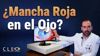 🔴 ¿Qué es la Hemorragia Subconjuntival? 🔍 Causas, Síntomas y Tratamientos Efectivos 2024
