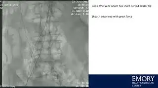 CVI 2019_Friday 7/19_ The Boundaries of Structural Heart Therapy I_Adam Greenbaum, MD