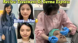 Review Jujur Treatment di Derma Express (Meso Glow  dan Laser)