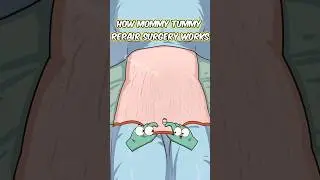 How Mommy Tummy Repair Surgery Works