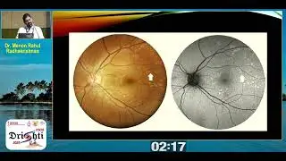 KSOS 2025  IC9  T Dr Menon Rahul Radhakrishnan  Retinal pigmentation! Benign finding or life threate