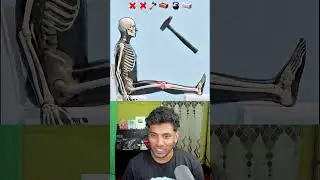 What Can Break Your Leg? 🦵