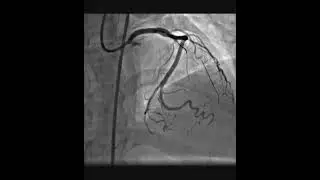 In stent CTO.