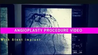 How heart stent inserted | Angioplasty Procedure video of heart | Stent Placement in Heart
